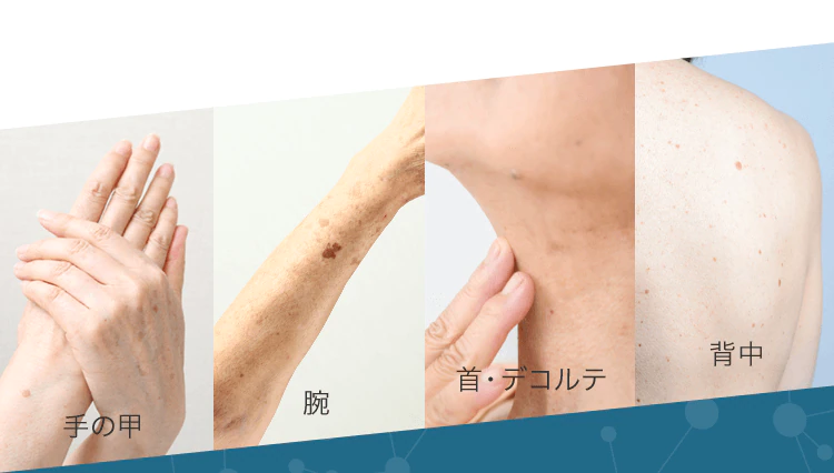 全身のシミ